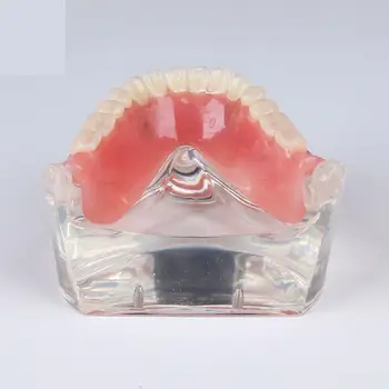 Стоматологическая Модель Обучения Изучению зубов Overdenture Inferior 4 Демонстрационная Модель имплантата Изображение